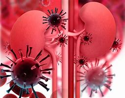 Image result for HIV Nephropathy