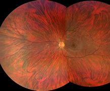 Image result for Fundus Tigroide Retina