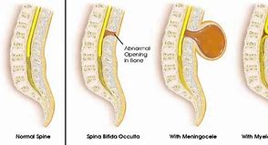 Image result for Spina Bifida Anencephaly UdeM