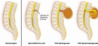 Image result for Spina Bifida and Anencephaly Caused By
