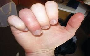 Image result for How to Treat Jammed Finger