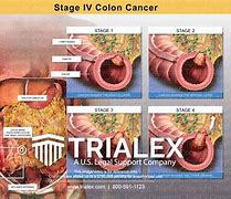 Image result for Colon Cancer Tumor Size