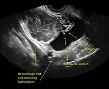 Image result for Hemorrhagic Ovarian Cyst Ultrasound