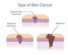 Image result for Show Photo of Skin Cancer Onset
