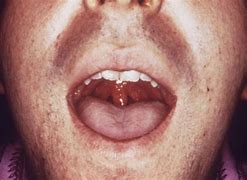 Image result for chlamydia on lip pictures