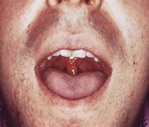 Image result for Gonorrhea of Mouth