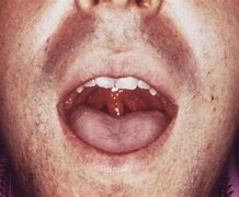 Image result for Gonorrhea of the Throat