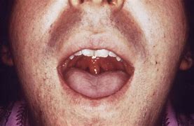 Image result for Gonorrhea of the Mouth