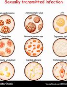 Image result for Sexually Transmitted Infection