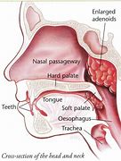 Image result for adenoidep