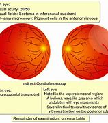 Image result for Retinal Detachment