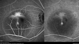 Image result for Central Serous Retinopathy Oct