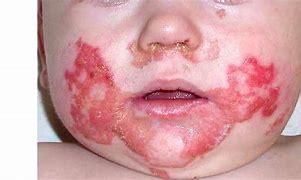 Image result for acrodermatitis_enteropathica