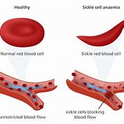 Image result for Person with Sickle Cell