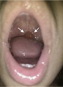 Image result for Growth On Uvula