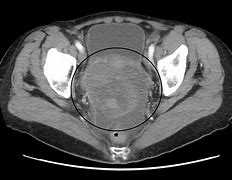 Image result for Ovarian Cancer On MRI