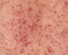 Image result for Folliculitis On Groin