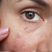 Image result for Localized Scleroderma Face