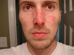 Image result for Dry Skin Rash On Face