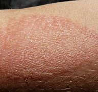 Image result for What Does Eczema Look Like