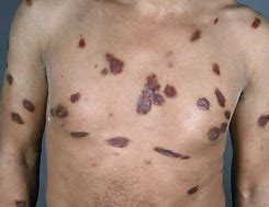 Image result for AIDS-associated Kaposi Sarcoma