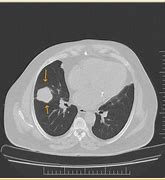 Image result for CXR Lungs Solitary Pulmonary Nodule