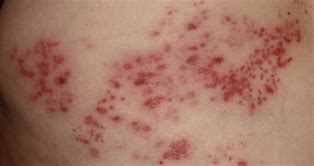 Image result for Herpes Zoster