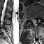 Image result for Back Brace for Spinal Stenosis