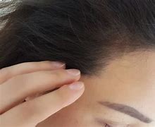 Image result for Female Hairline Microblading