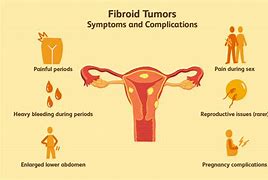 Image result for Uterus with Fibroids