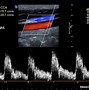 Image result for Carotid Ultrasound Velocities