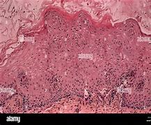 Image result for Warts On Cervix