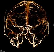 Image result for Circle of Willis 3D CT