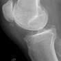 Image result for Bone Spur On Knee