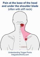 Image result for Sharp Pain Back of Head
