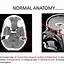 Image result for Brain CT Scan Head