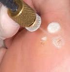 Image result for Wart to Back of Leg Cryotherapy