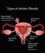 Image result for Fibroid Tumors