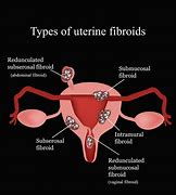 Image result for 5 cm fibroids removal
