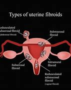 Image result for Subserous Fibroids