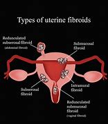 Image result for 10 Cm Fibroid Photos