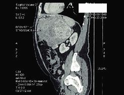 Image result for 16 Cm Tumor