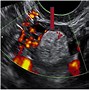 Image result for Functional Ovarian Cyst Ultrasound