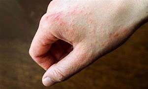 Image result for Pollen Allergy Rash