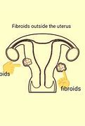 Image result for 11 Cm Fibroid