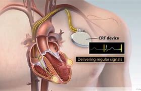 Image result for ICD Vs. CRT