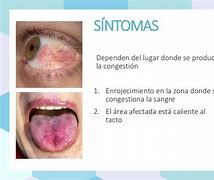 Image result for hiperemia