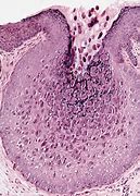 Image result for Molluscum Contagiosum Pathology