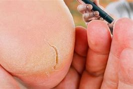 Image result for Diabetic Plantar Warts On Feet
