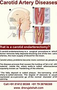 Image result for Post Carotid Endarterectomy